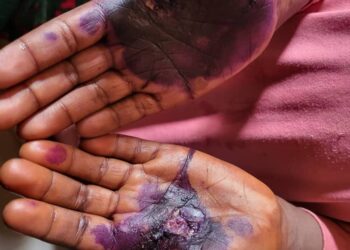 Kankan: Une femme brûle les mains de son homonyme pour  vol d&rsquo; argent.